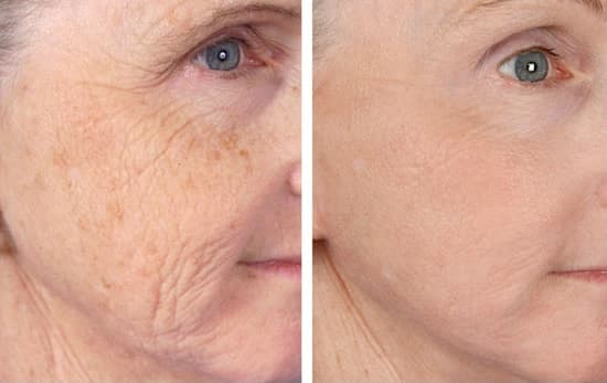 Radio Frequency Machine Mmfu Cyclone Rf Painless Face Lift Rf Machine For Skin Tightening Wrinkle Remover