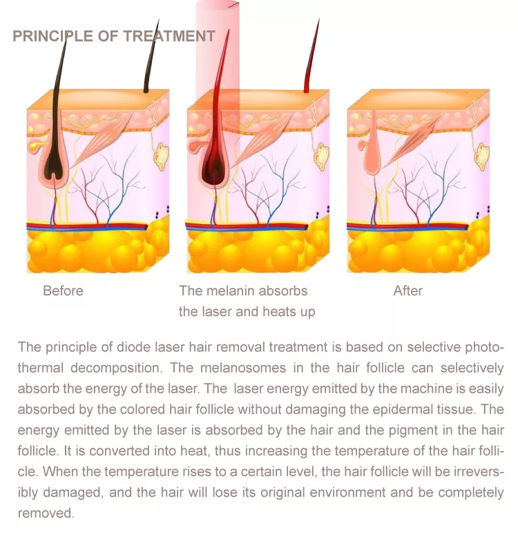 Dual Handles 3 Wavelength Laser Diode 808Nm Hair Removal Treatment Beauty Machine