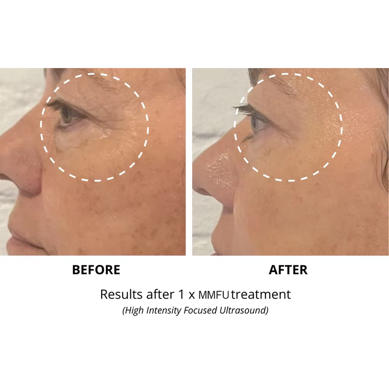 2 in 1 7D hifu RF face lift machine hifu face and body tighten Machine