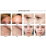 2023 New VDHF rf radio high frequency skin tightening machine best wrinkle remover equipment beauti lifting face care product